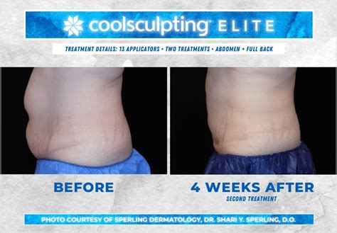 coolsclupting|coolsculpting stomach before and after.